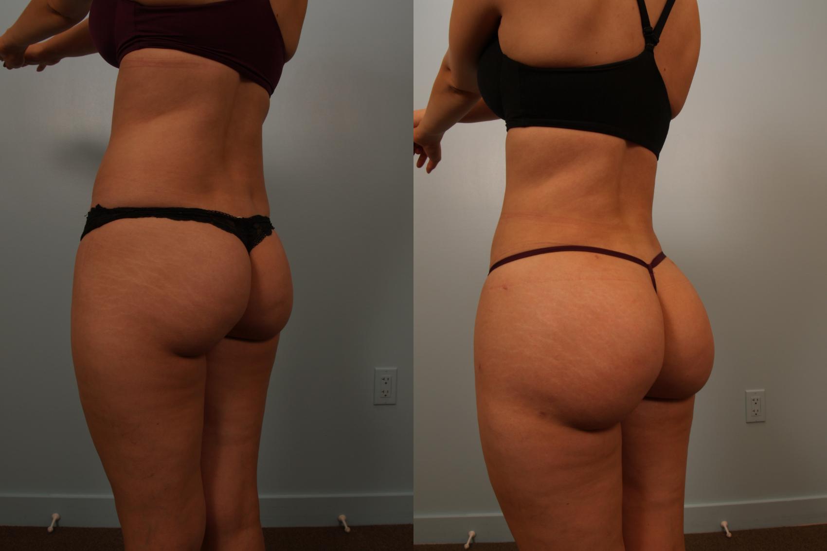 Before & After Brazilian Buttock Lift Case 131 View #2 View in Gilbert, AZ