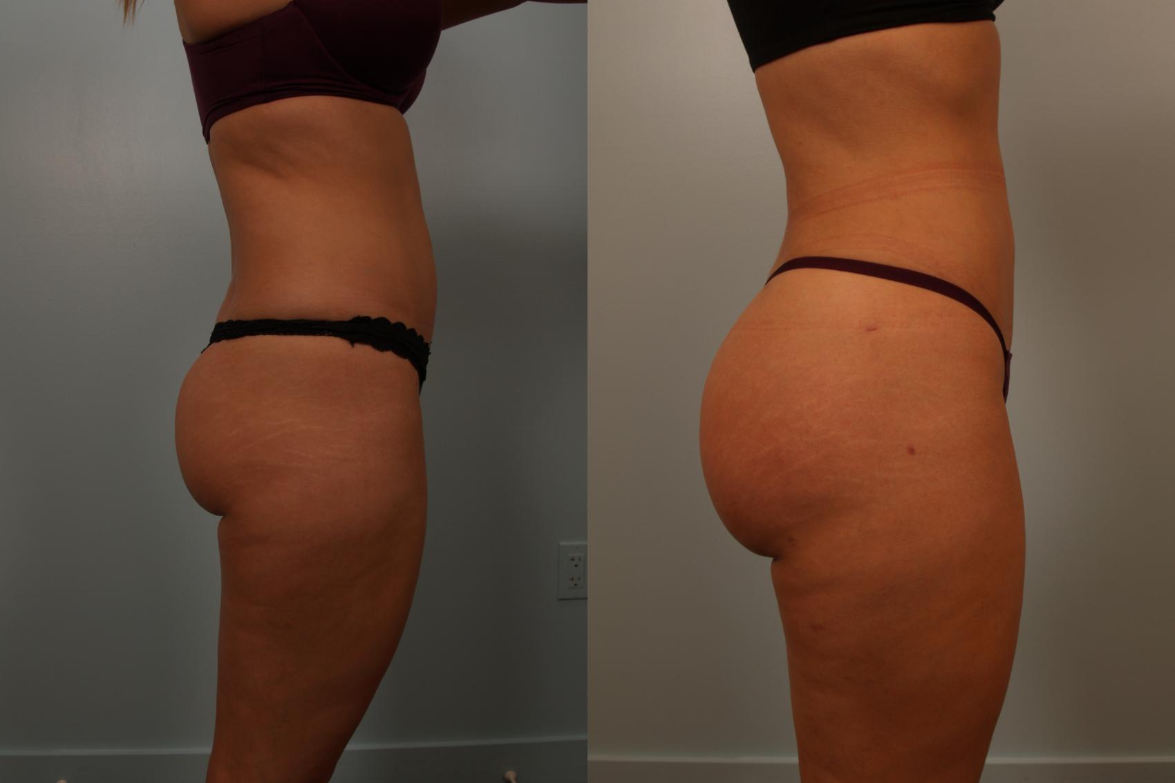 Before & After Brazilian Buttock Lift Case 131 View #4 View in Gilbert, AZ
