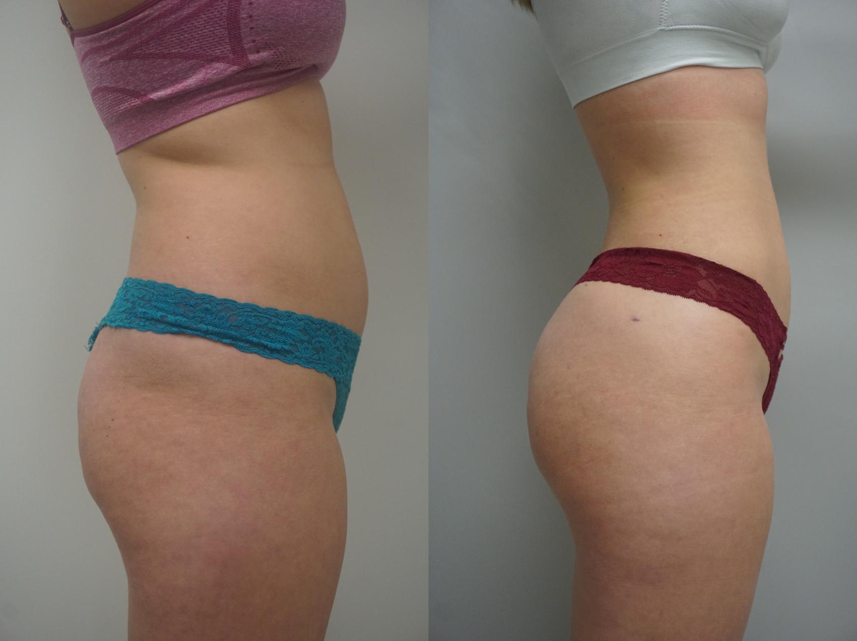 Before & After Brazilian Buttock Lift Case 262 View #2 View in Gilbert, AZ