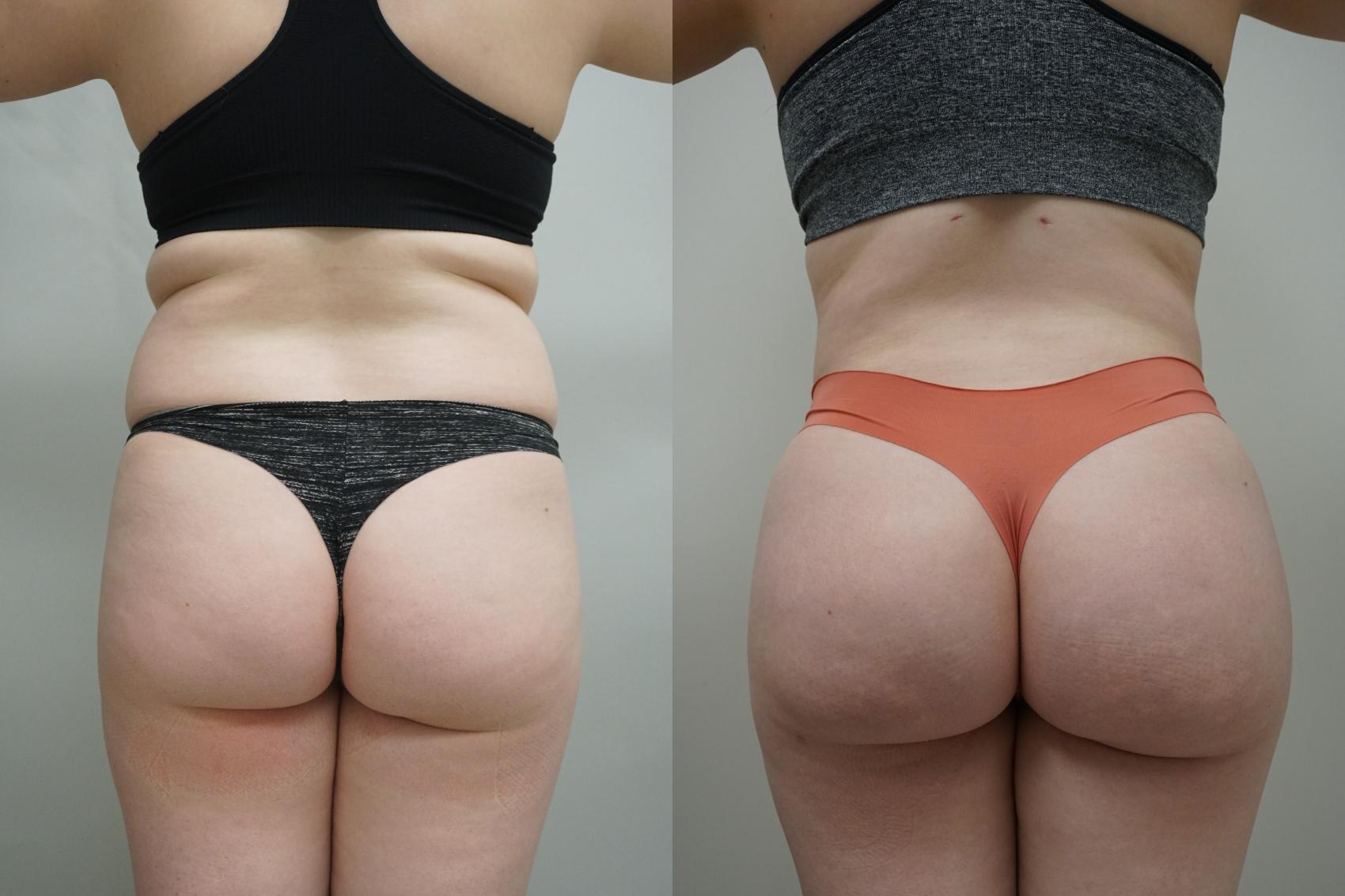 Before & After Brazilian Buttock Lift Case 296 Back View in Gilbert, AZ