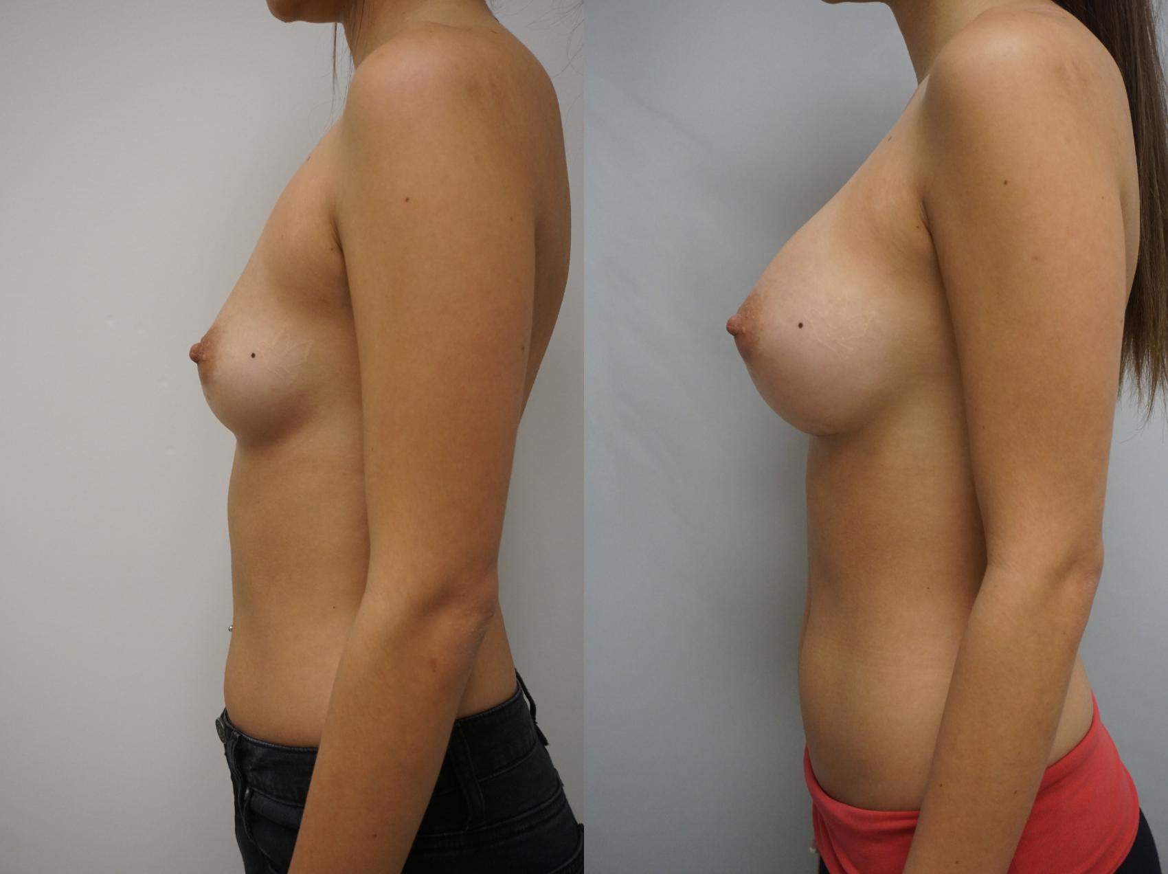 Before & After Breast Augmentation Case 136 View #3 View in Gilbert, AZ