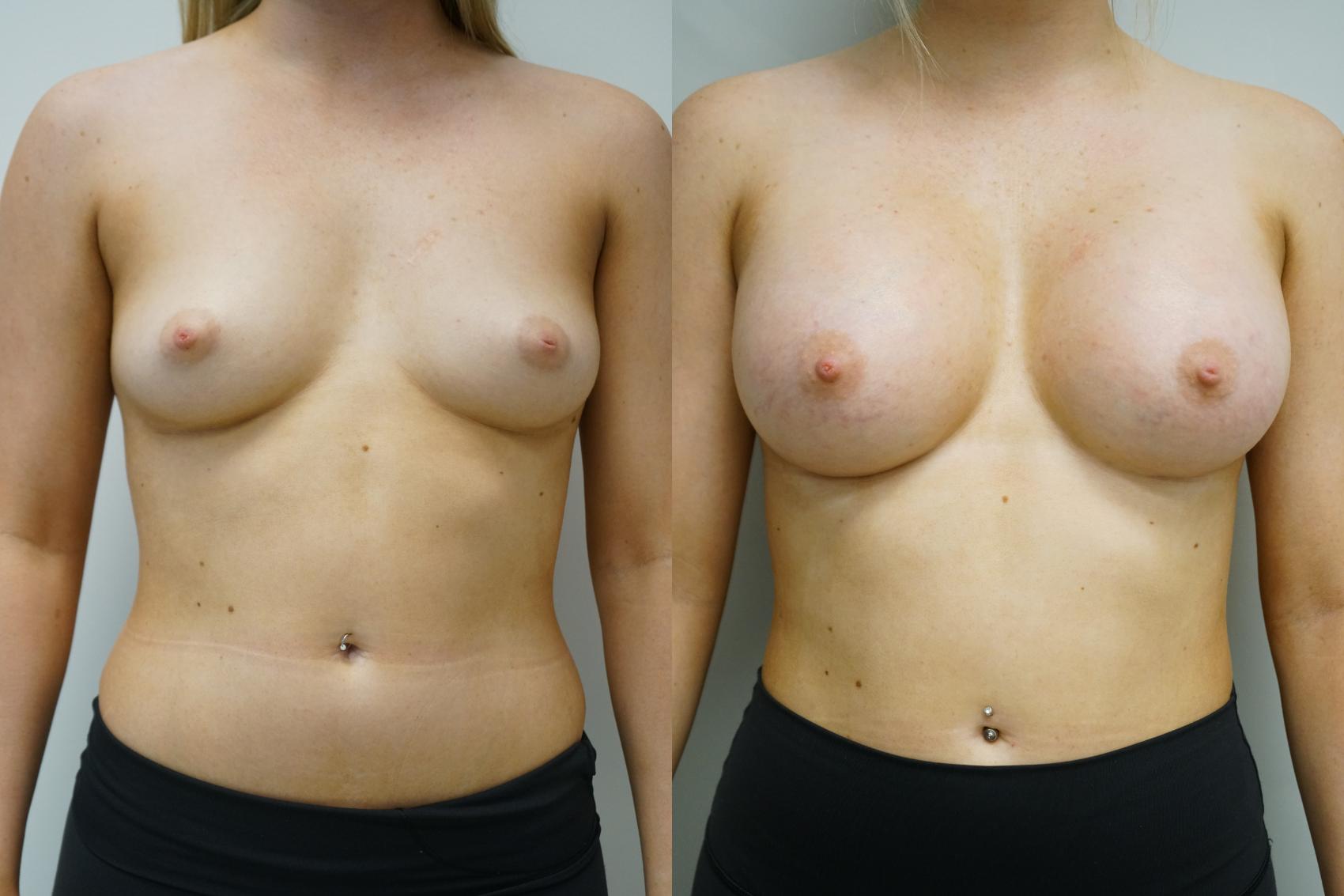 Before & After Breast Augmentation Case 373 Front View in Gilbert, AZ
