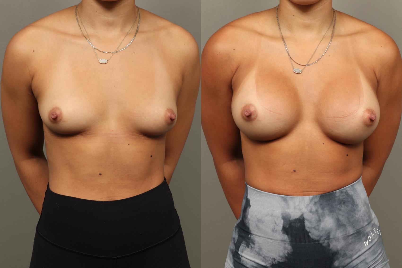 Before & After Breast Augmentation Case 468 Front View in Gilbert, AZ