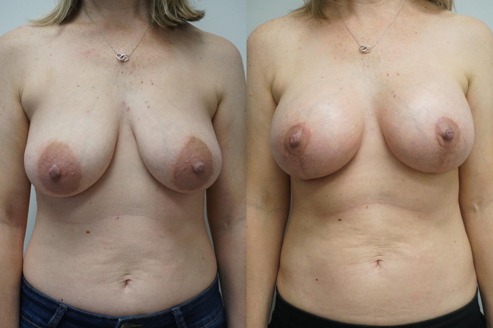 Before & After Breast Augmentation with Breast Lift Case 285 Front View in Gilbert, AZ