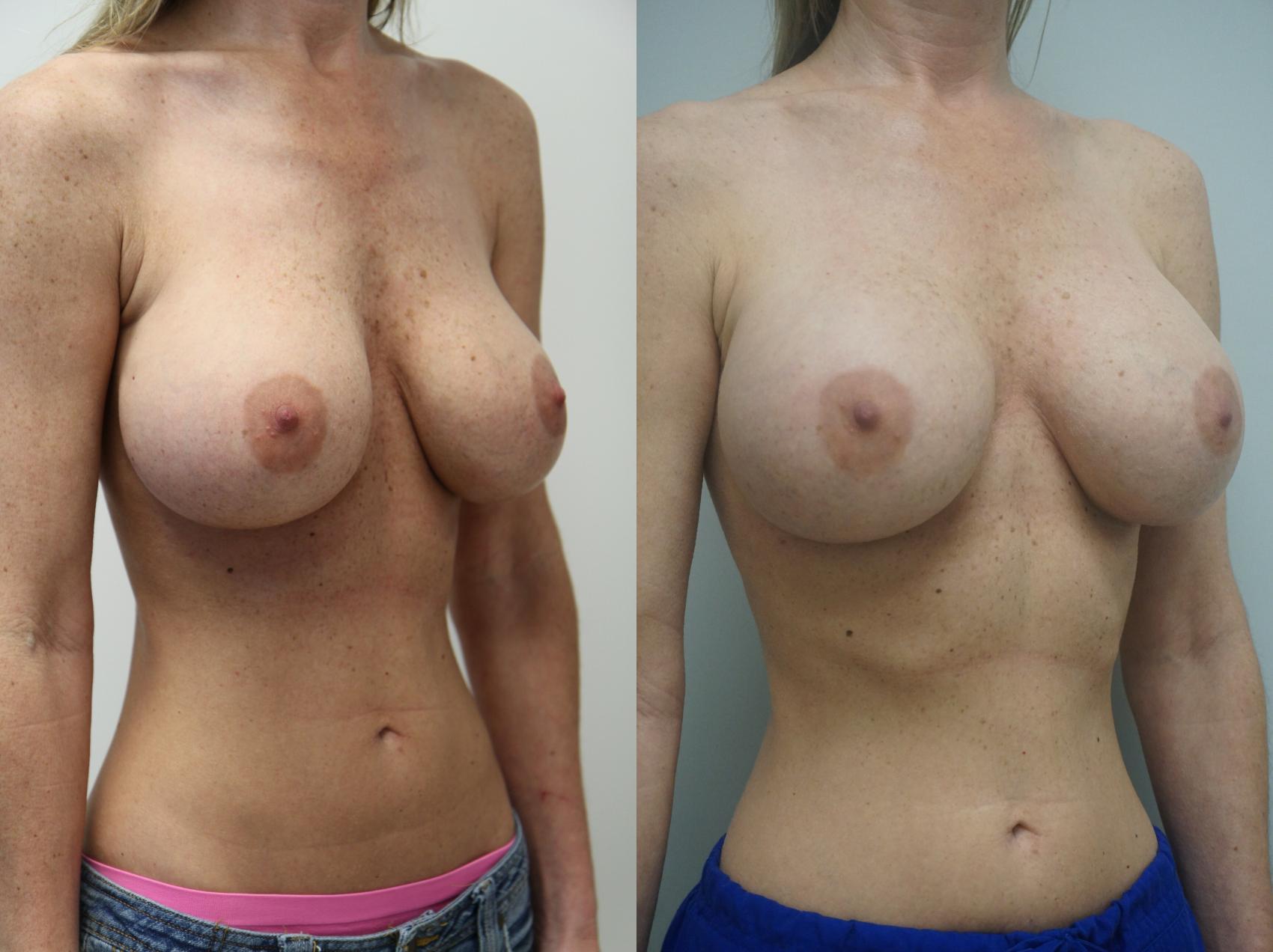 Before & After Breast Implant Exchange Case 231 View #2 View in Gilbert, AZ