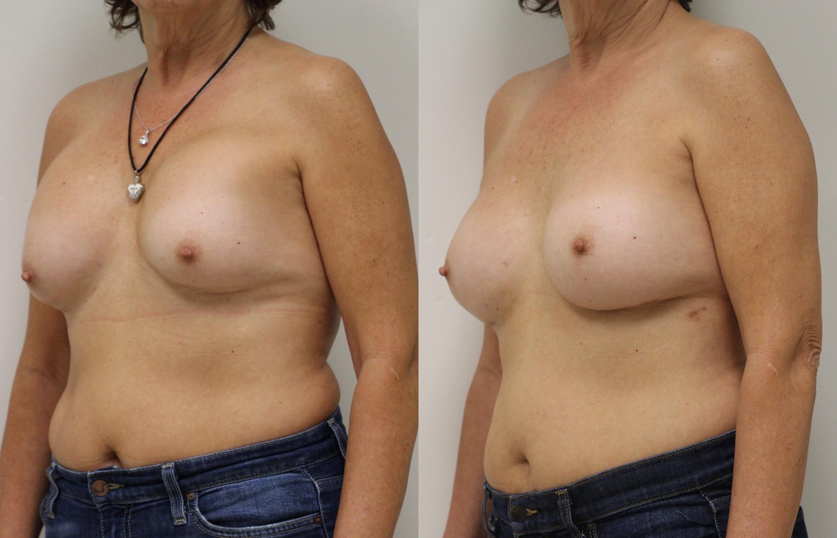 Before & After Breast Implant Exchange Case 35 View #3 View in Gilbert, AZ
