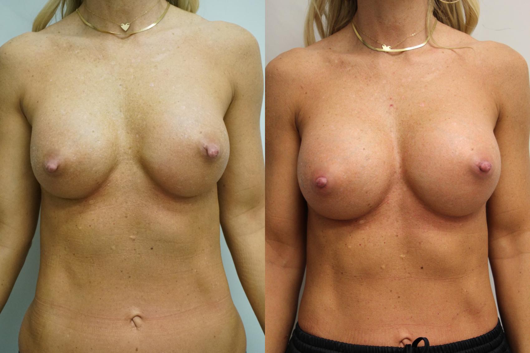 Before & After Breast Implant Exchange Case 426 Front View in Gilbert, AZ