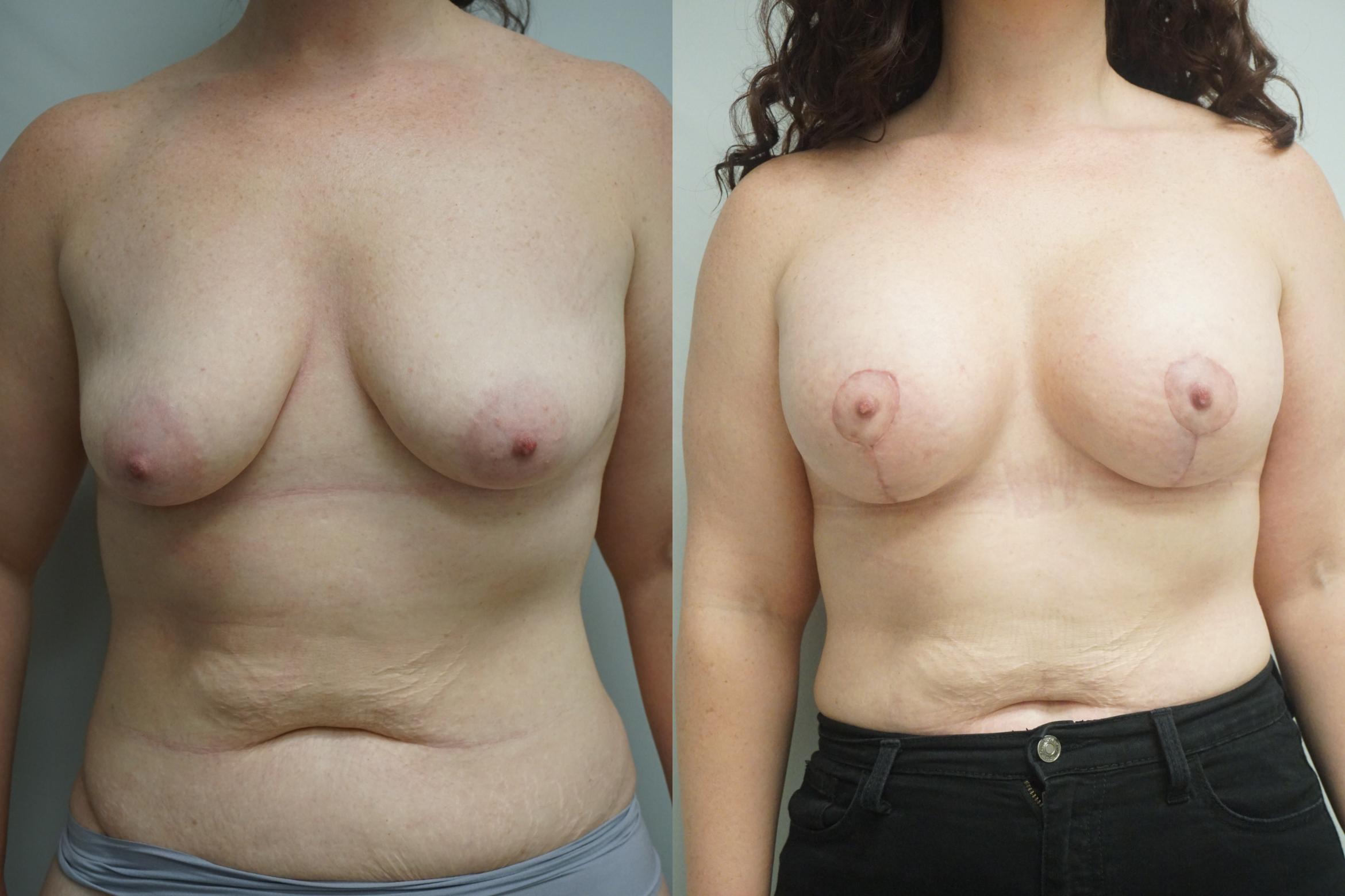 Breast Augmentation Before After Photos Patient 291 Gilbert AZ