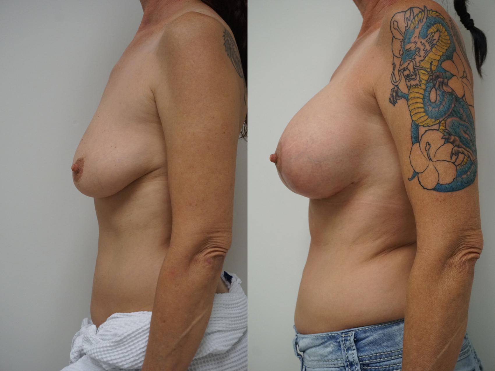 Before & After Breast Augmentation with Breast Lift  Case 100 View #3 View in Gilbert, AZ