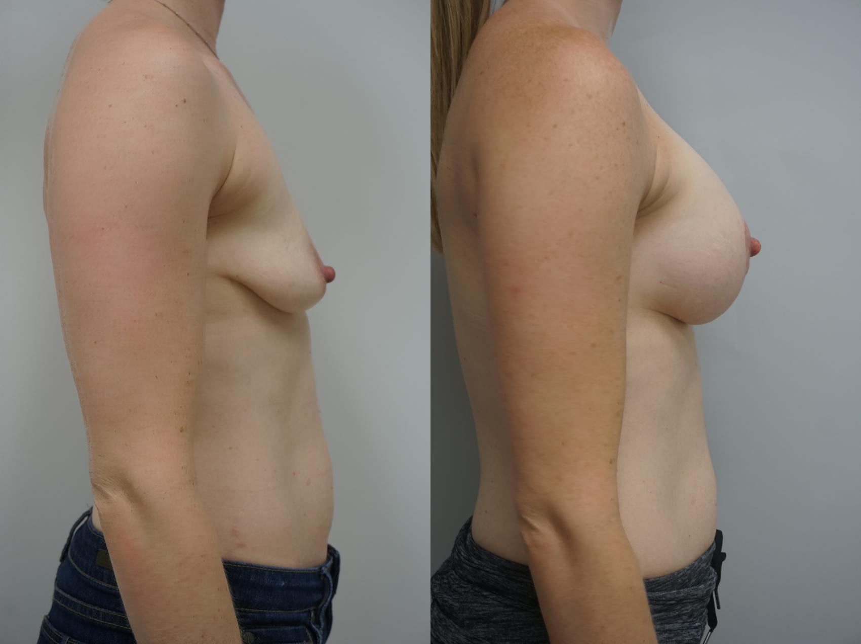 Before & After Breast Augmentation with Breast Lift  Case 172 View #1 View in Gilbert, AZ