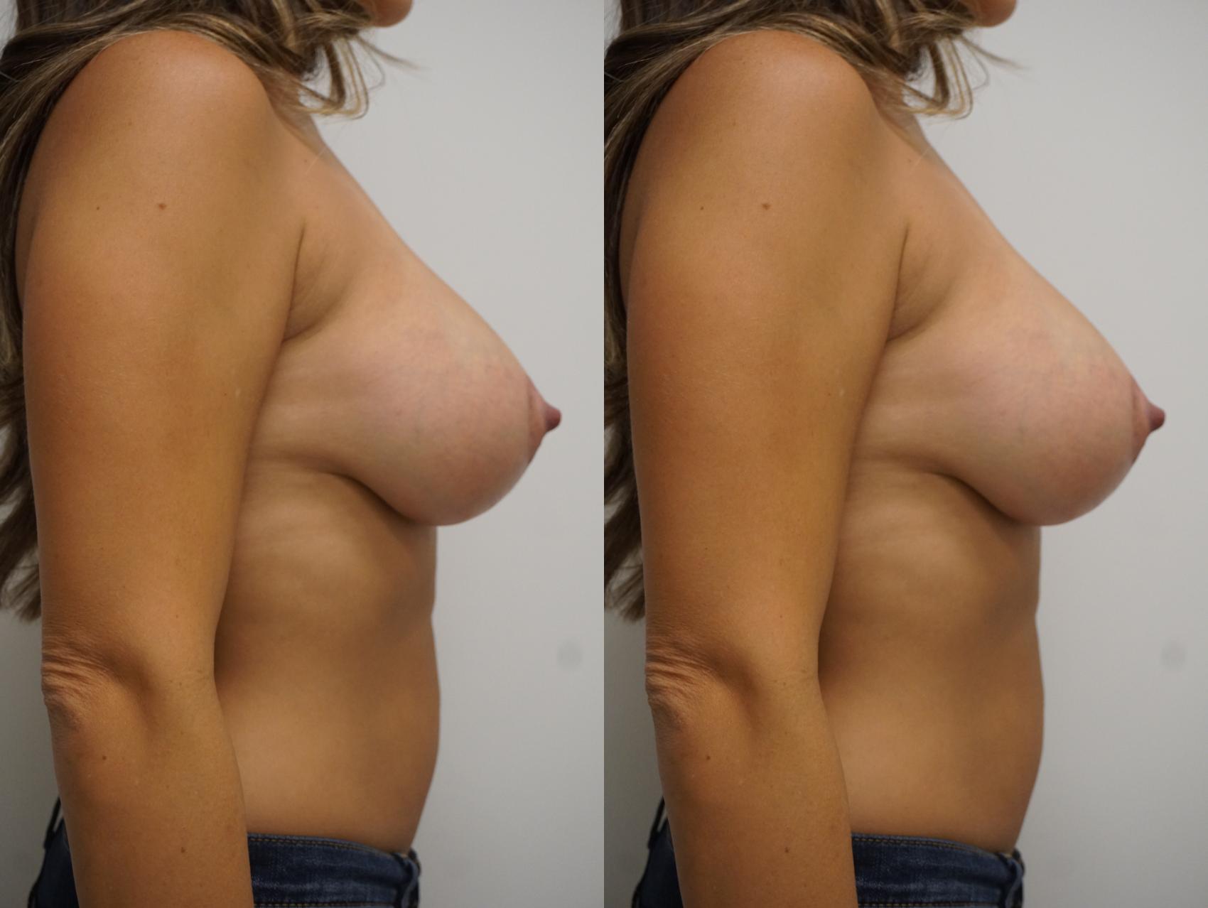 Before & After Breast Augmentation with Breast Lift  Case 77 View #3 View in Gilbert, AZ