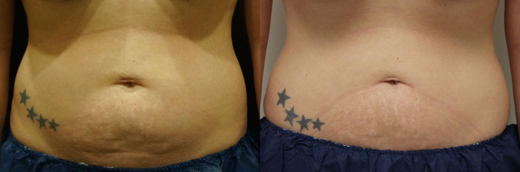 Before & After Coolsculpting Case 20 View #1 View in Gilbert, AZ