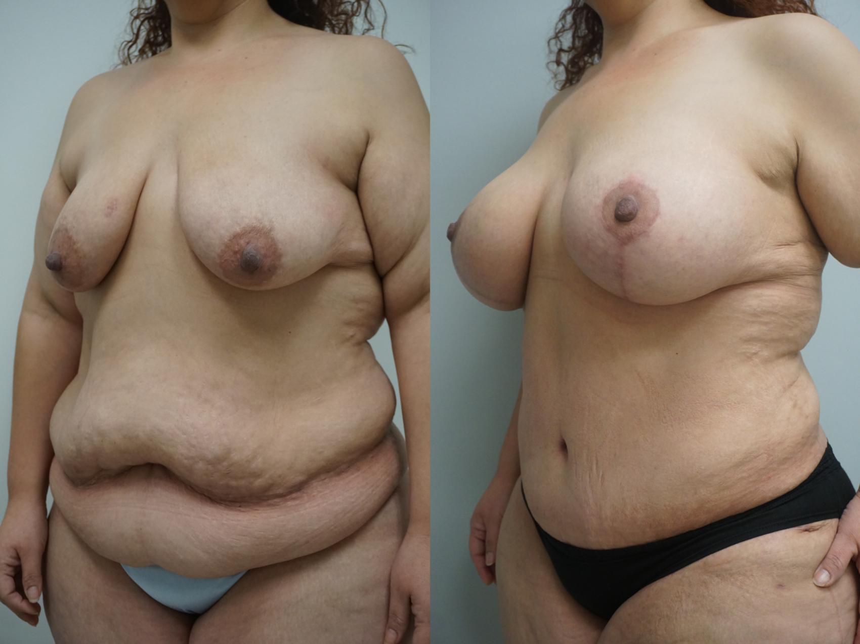 Before & After Mommy Makeover Case 114 View #2 View in Gilbert, AZ