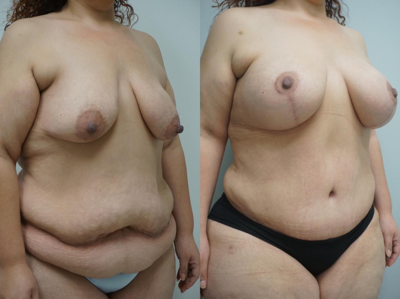 Before & After Mommy Makeover Case 114 View #3 View in Gilbert, AZ