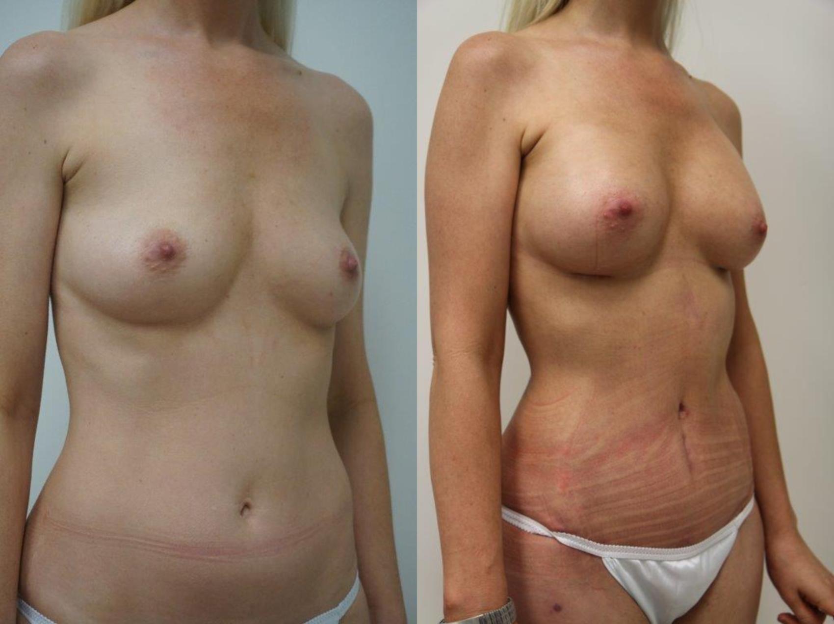 Before & After Mommy Makeover Case 123 View #3 View in Gilbert, AZ