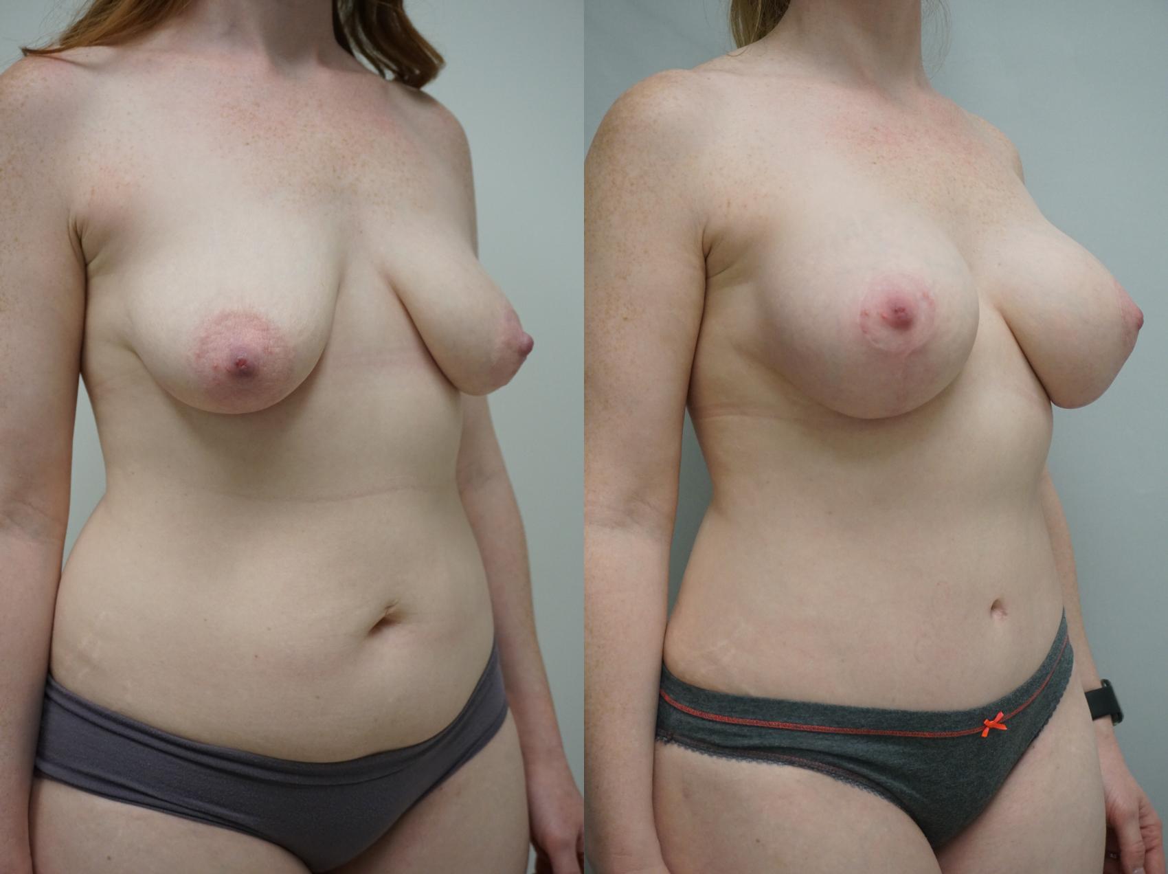 Before & After Mommy Makeover Case 141 View #2 View in Gilbert, AZ