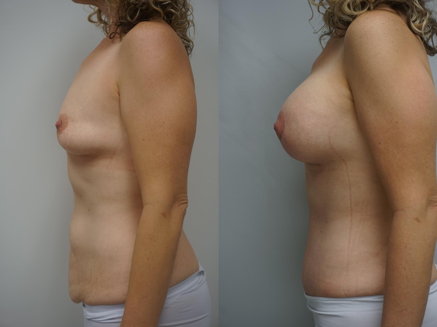 Before & After Mommy Makeover Case 186 View #3 View in Gilbert, AZ