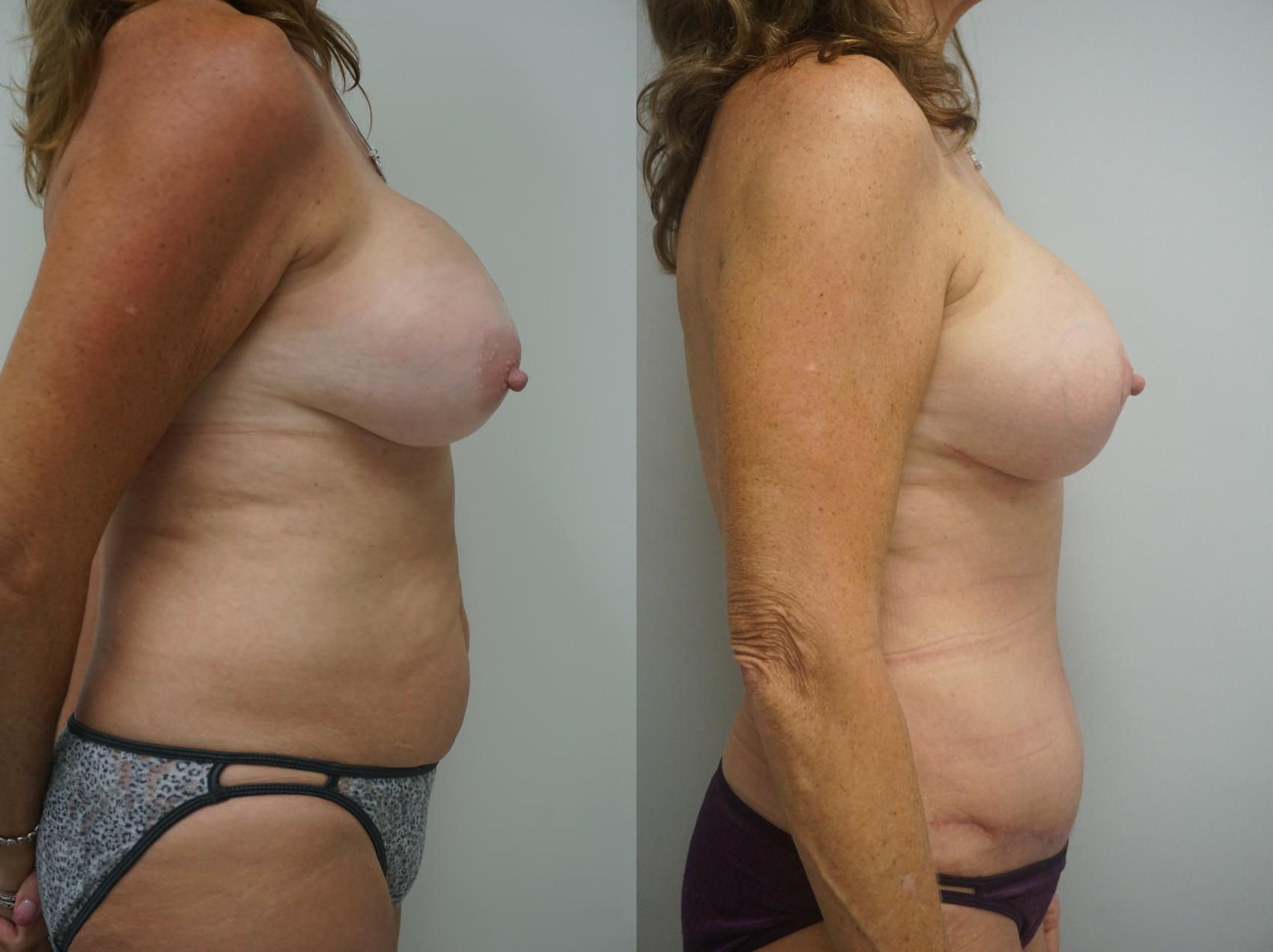 Before & After Mommy Makeover Case 222 View #2 View in Gilbert, AZ