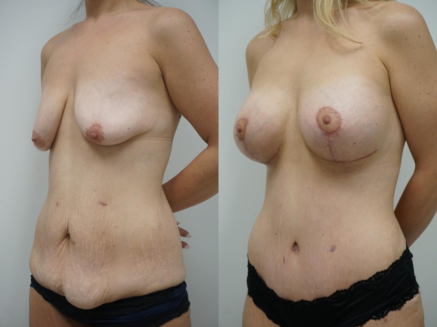 Before & After Mommy Makeover Case 272 View #2 View in Gilbert, AZ