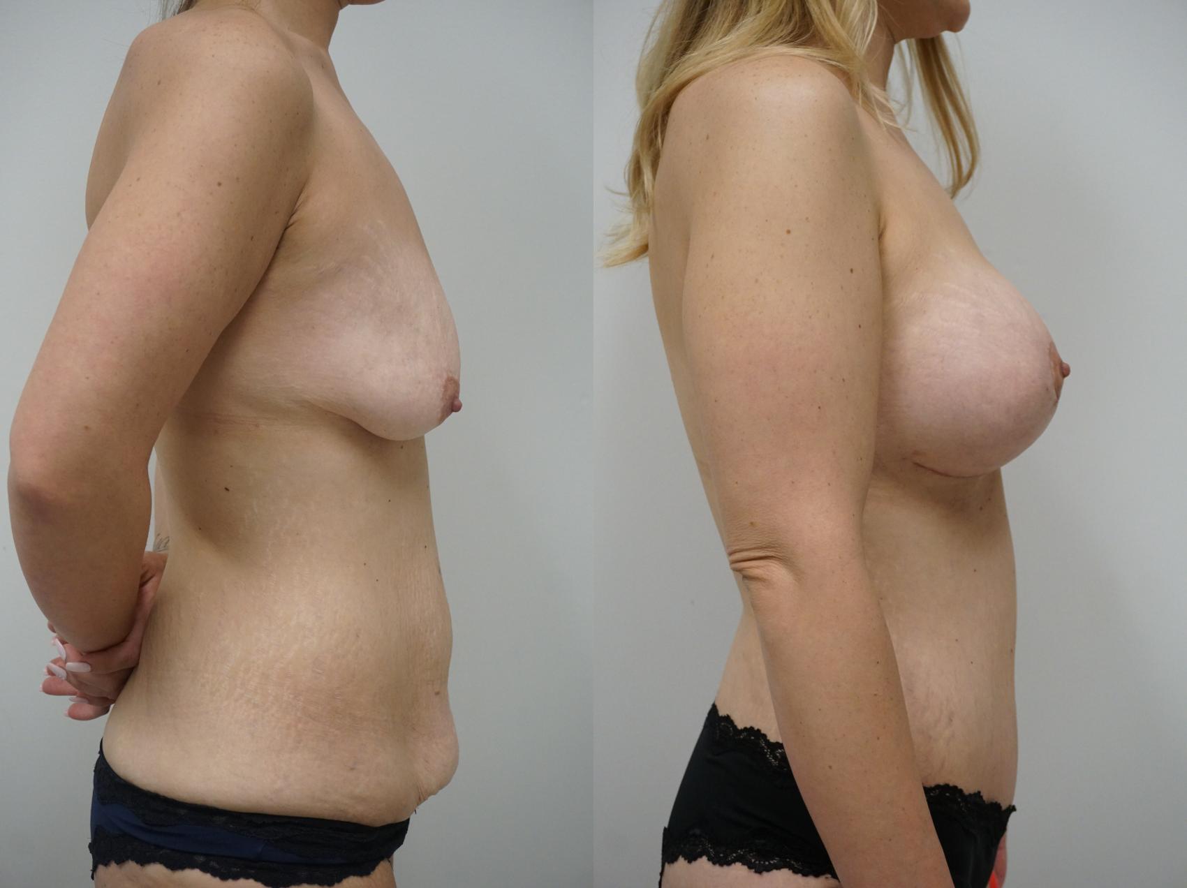 Before & After Mommy Makeover Case 272 View #3 View in Gilbert, AZ