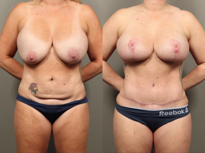 Before & After Mommy Makeover Case 488 Front View in Gilbert, AZ