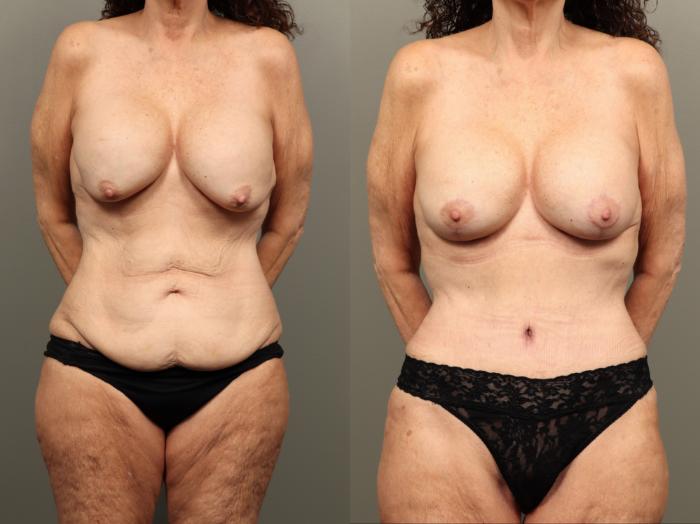 Before & After Mommy Makeover Case 490 Front View in Gilbert, AZ