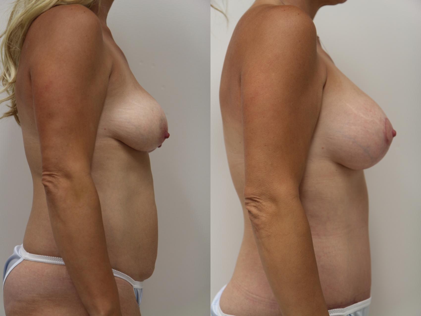 Before & After Mommy Makeover Case 85 View #3 View in Gilbert, AZ