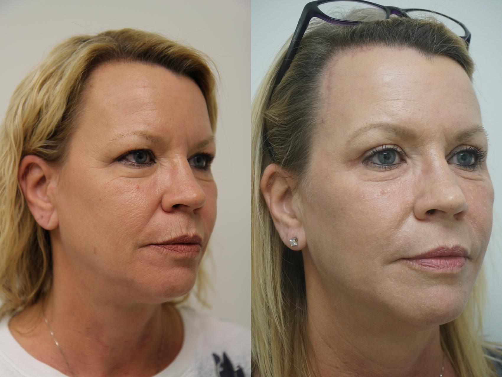 Before & After Renuvion J-Plasma Skin Tightening Case 95 View #2 View in Gilbert, AZ
