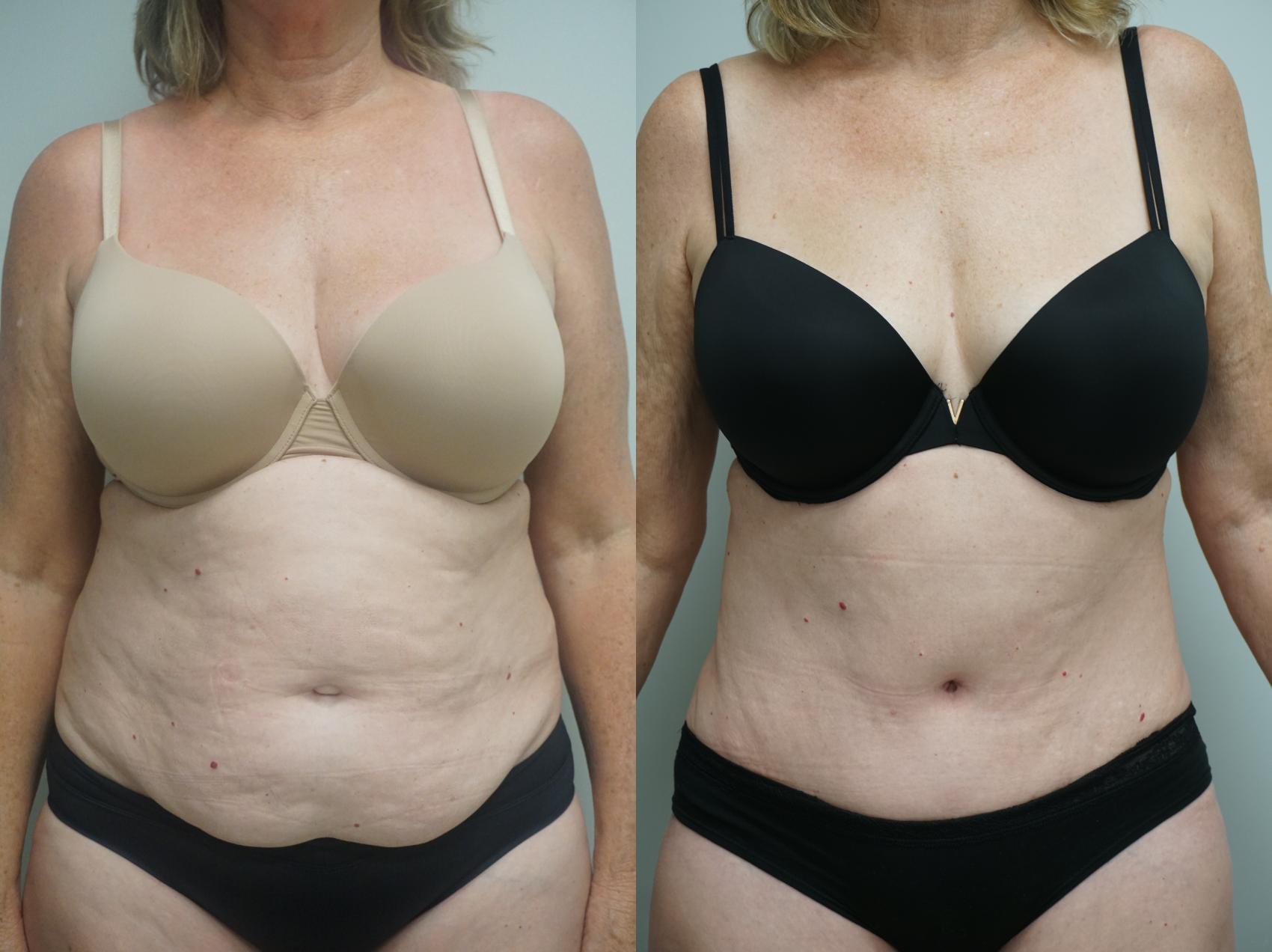 Before & After Abdominoplasty (Tummy Tuck) Case 201 View #2 View in Gilbert, AZ