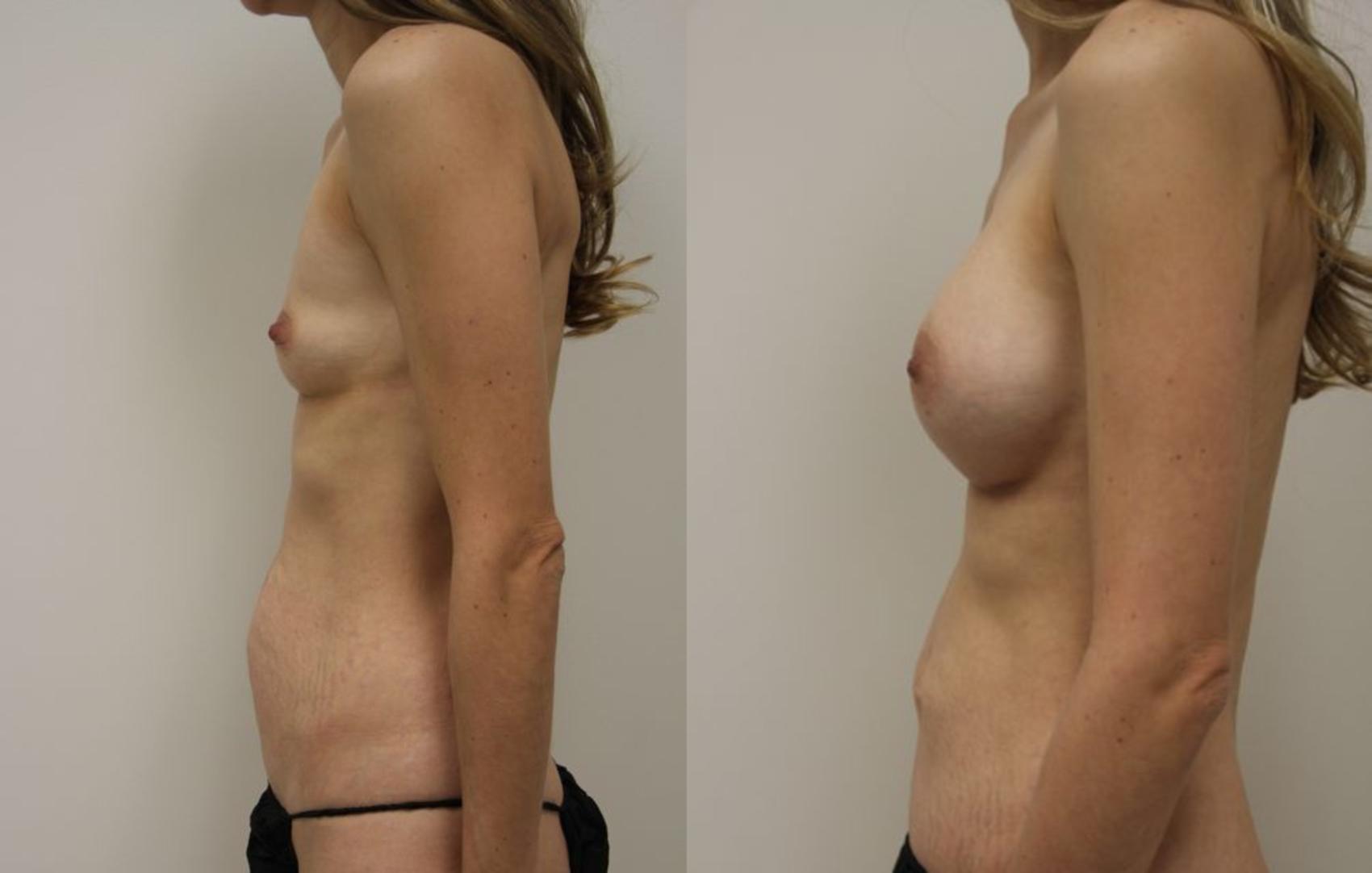 Before & After Abdominoplasty (Tummy Tuck) Case 28 View #3 View in Gilbert, AZ