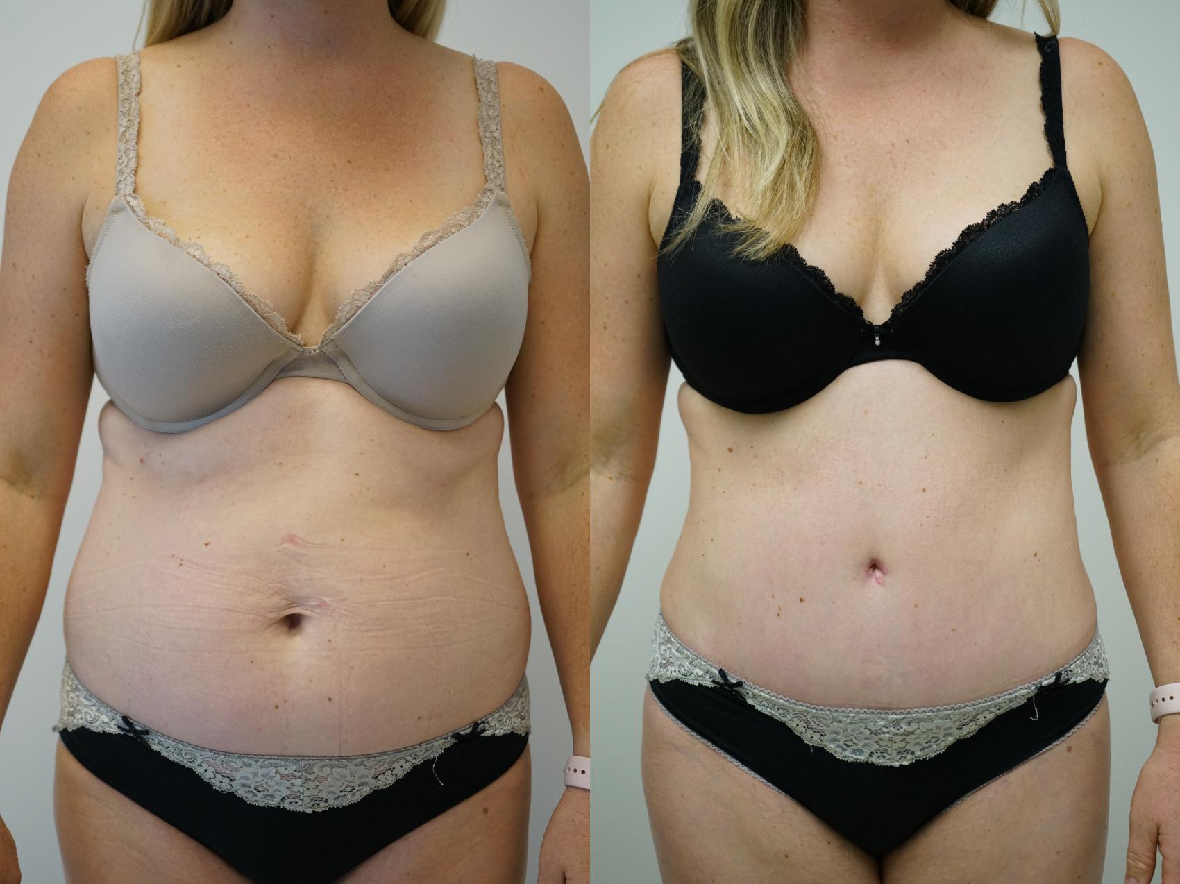 Abdominoplasty Tummy Tuck Before And After Pictures Case 366