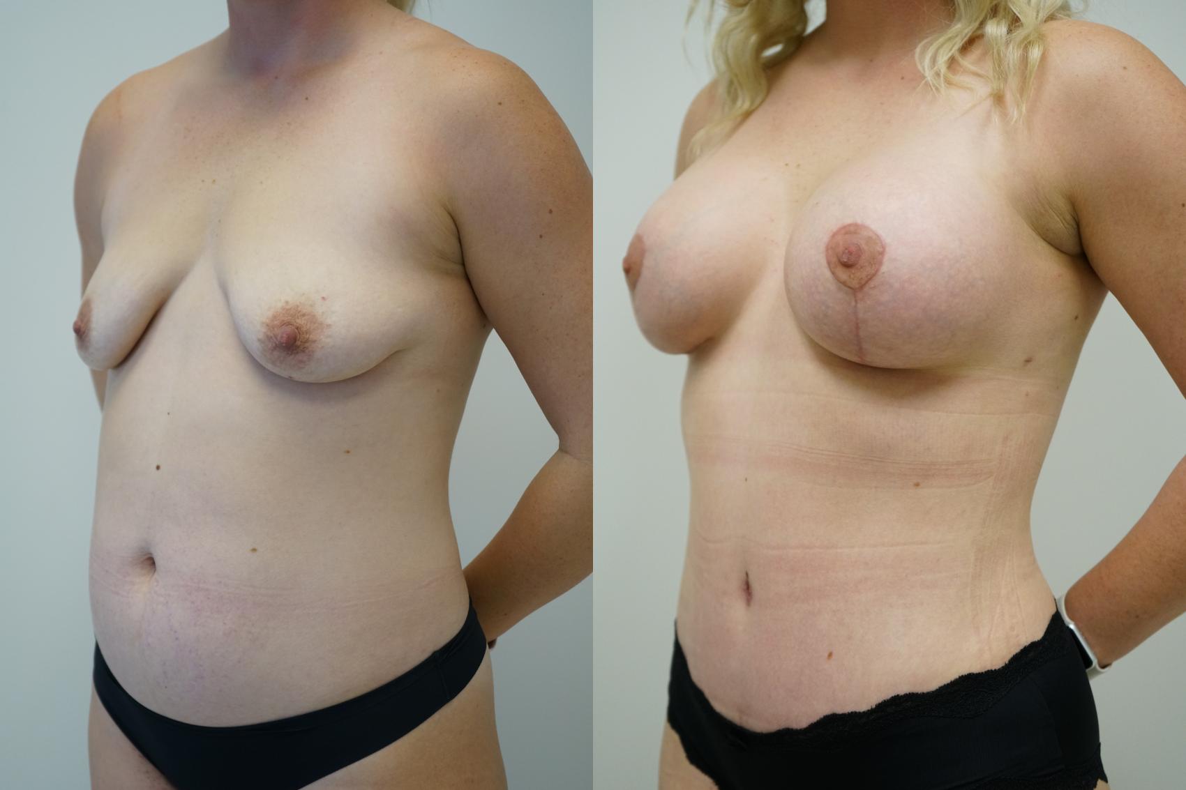 Before & After Abdominoplasty (Tummy Tuck) Case 384 Left Oblique View in Gilbert, AZ