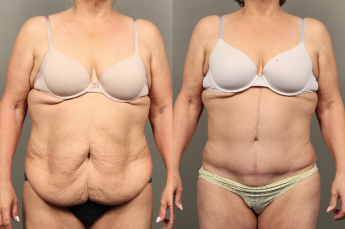 Before & After Abdominoplasty (Tummy Tuck) Case 455 Front View in Gilbert, AZ