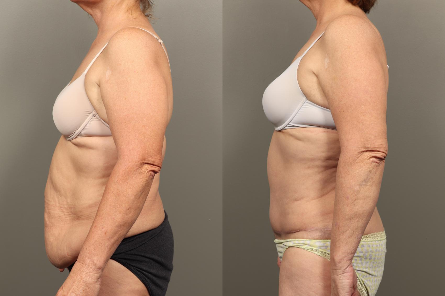 Before & After Abdominoplasty (Tummy Tuck) Case 455 Left Side View in Gilbert, AZ