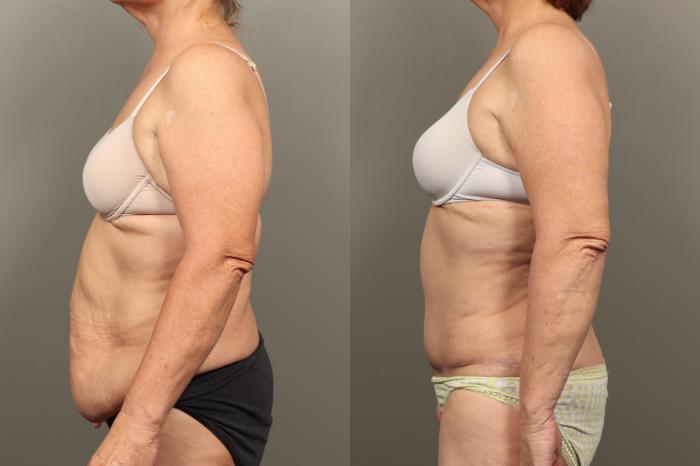 Before & After Abdominoplasty (Tummy Tuck) Case 455 Left Side View in Gilbert, AZ