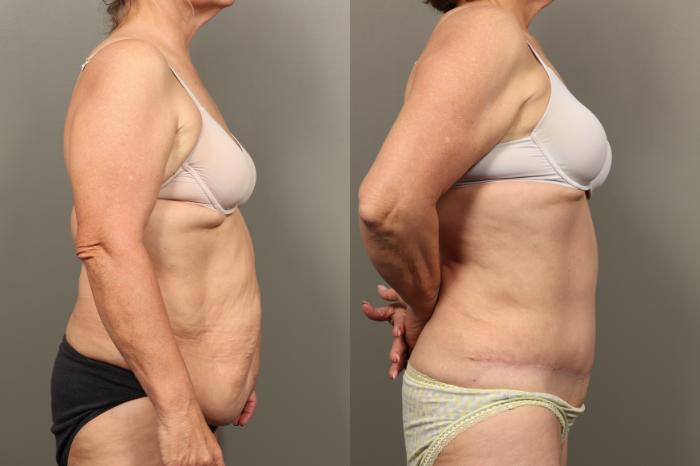 Before & After Abdominoplasty (Tummy Tuck) Case 455 Right Oblique View in Gilbert, AZ