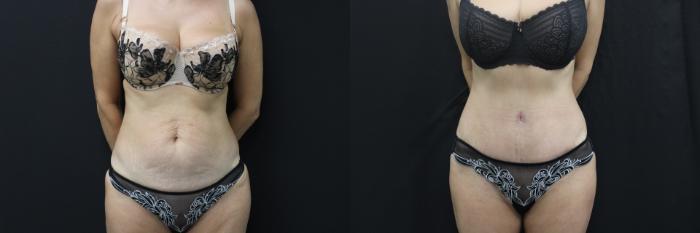 Before & After Abdominoplasty (Tummy Tuck) Case 459 Front View in Gilbert, AZ