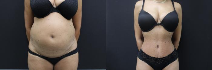 Before & After Abdominoplasty (Tummy Tuck) Case 461 Front View in Gilbert, AZ