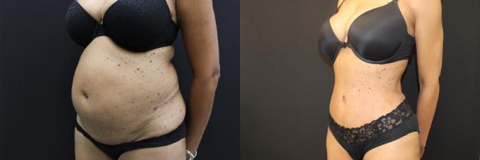 Before & After Abdominoplasty (Tummy Tuck) Case 461 Left Oblique View in Gilbert, AZ