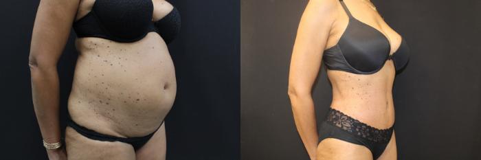 Before & After Abdominoplasty (Tummy Tuck) Case 461 Right Oblique View in Gilbert, AZ