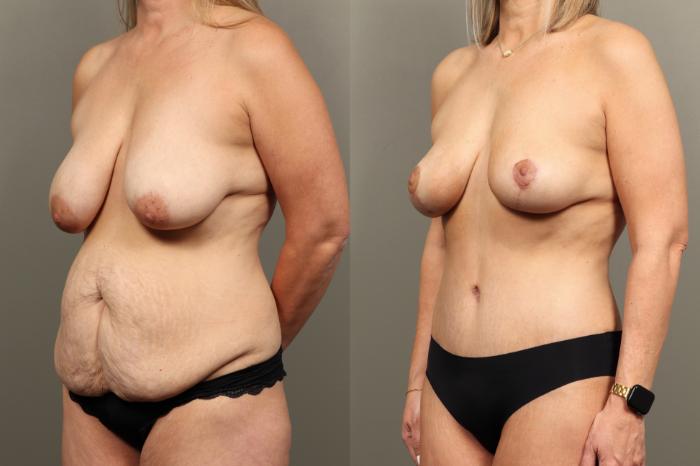 Before & After Breast Lift (No Implants) Case 467 Left Oblique View in Gilbert, AZ