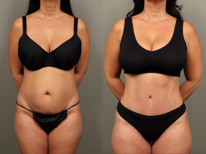 Before & After Abdominoplasty (Tummy Tuck) Case 483 Front View in Gilbert, AZ