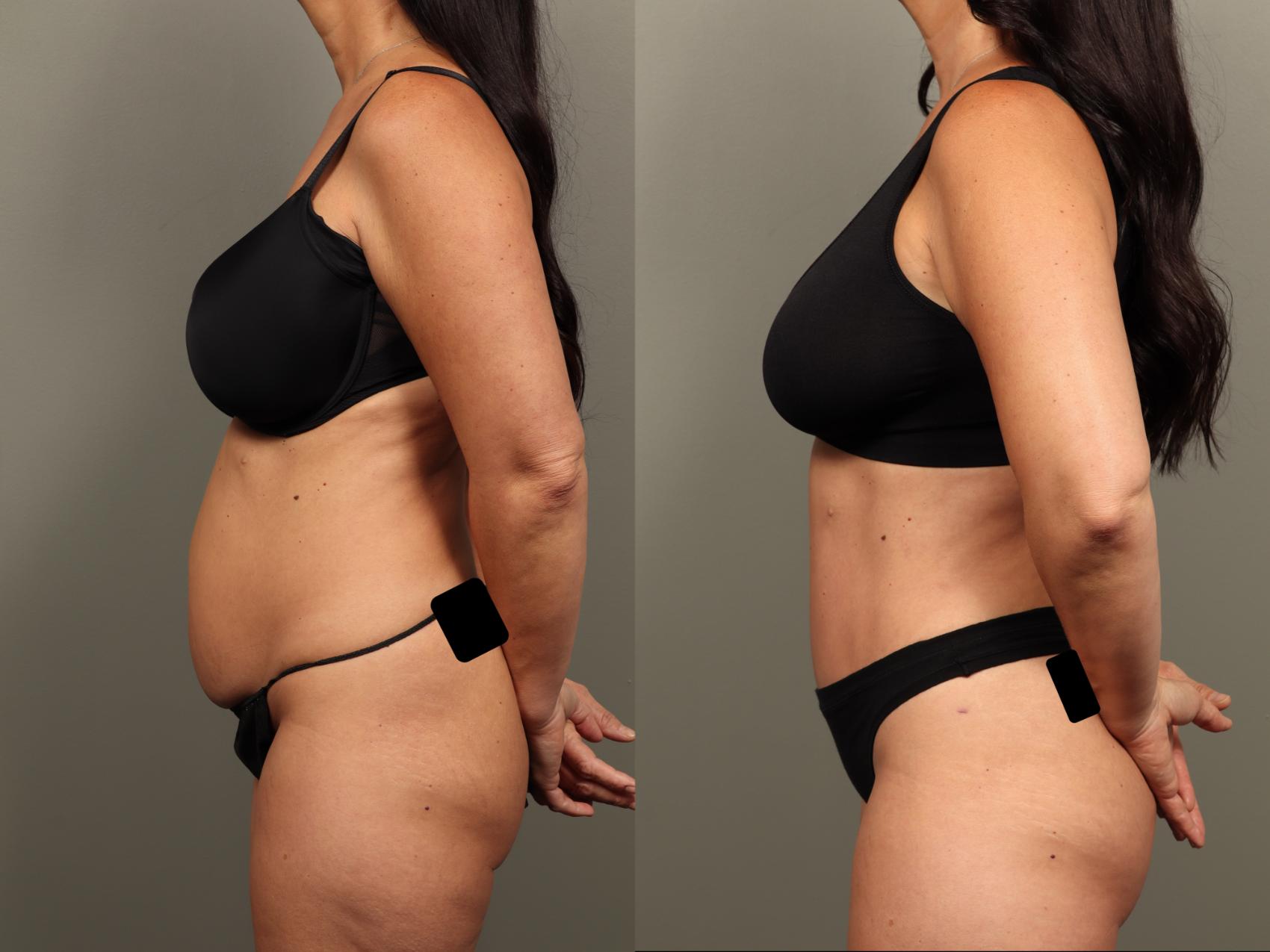 Before & After Abdominoplasty (Tummy Tuck) Case 483 Left Side View in Gilbert, AZ