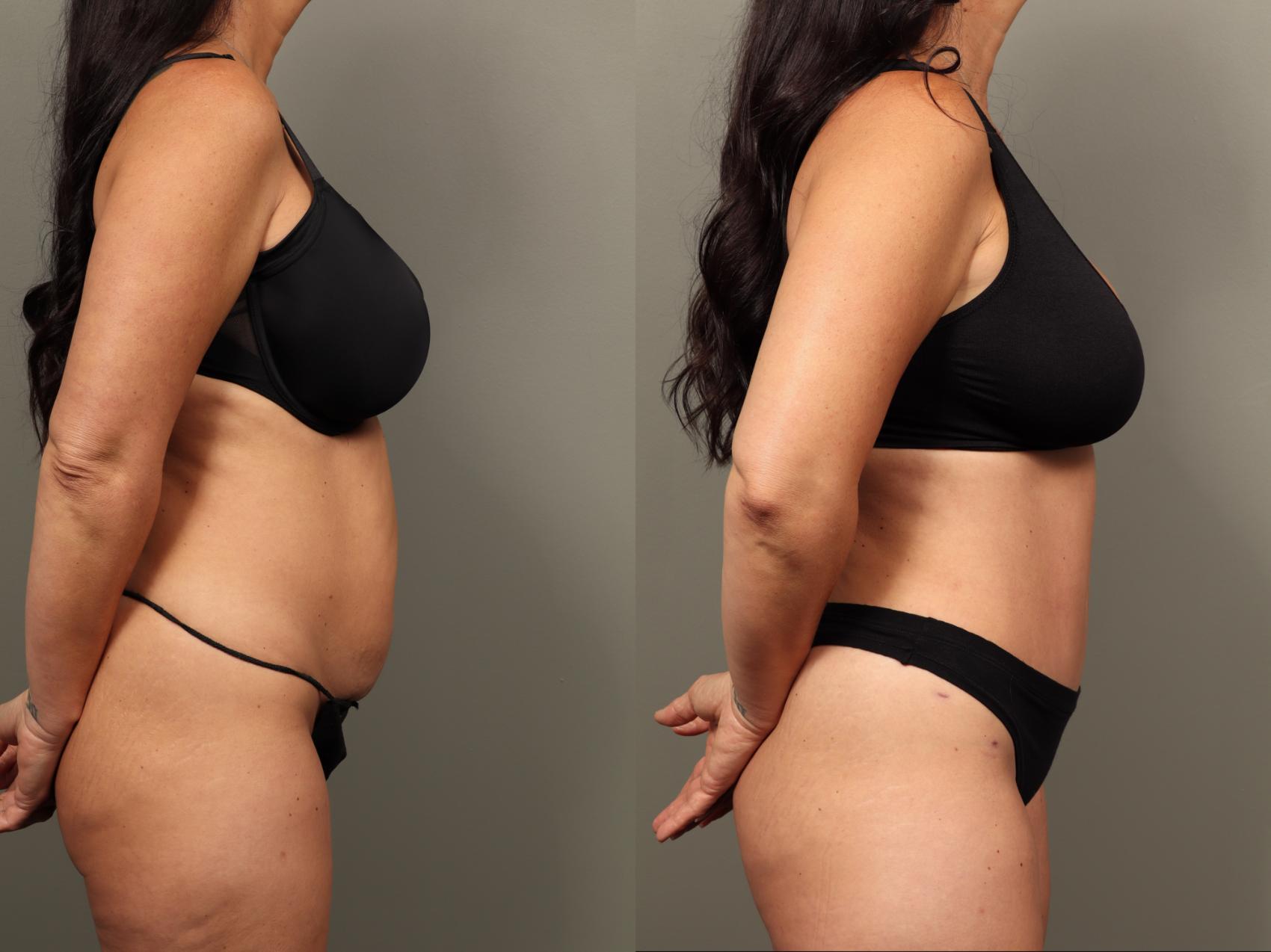 Before & After Abdominoplasty (Tummy Tuck) Case 483 Right Side View in Gilbert, AZ