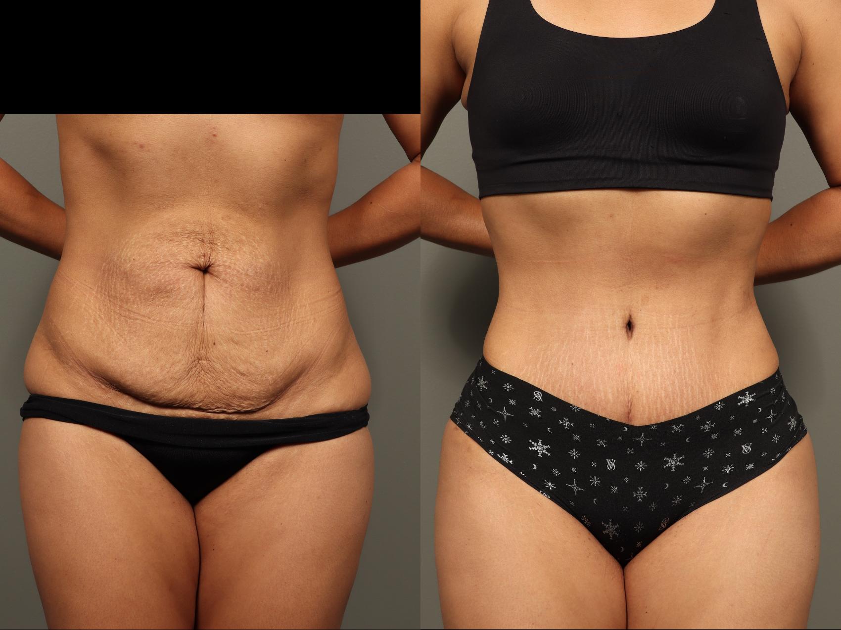 Before & After Abdominoplasty (Tummy Tuck) Case 499 Front View in Gilbert, AZ