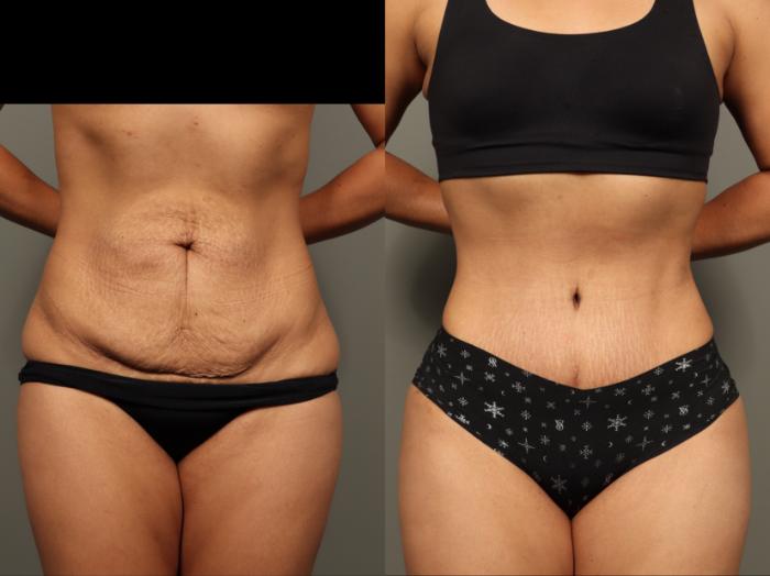 Before & After Abdominoplasty (Tummy Tuck) Case 499 Front View in Gilbert, AZ
