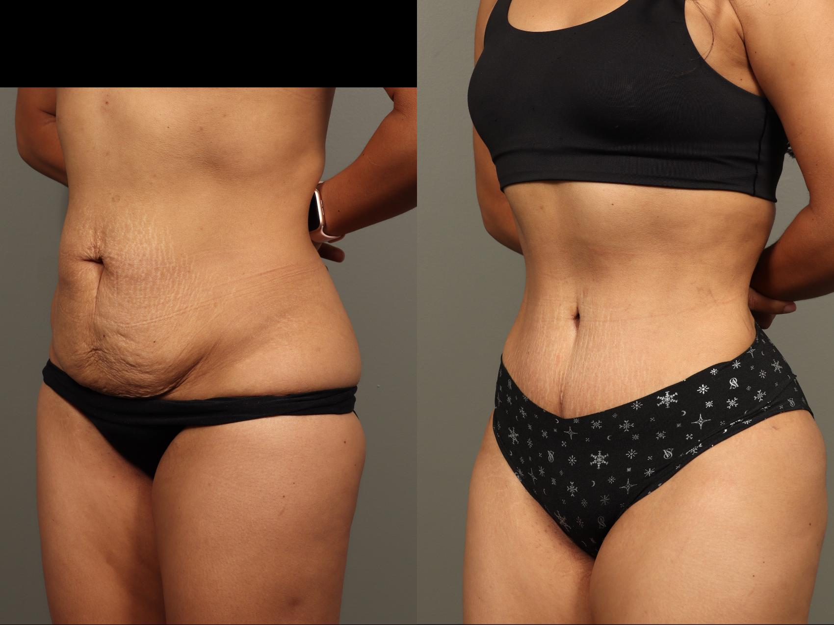 Before & After Abdominoplasty (Tummy Tuck) Case 499 Left Oblique View in Gilbert, AZ
