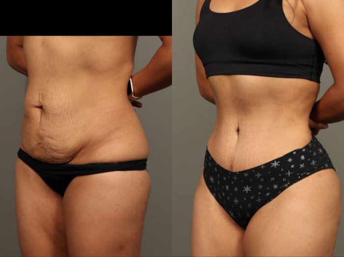 Before & After Abdominoplasty (Tummy Tuck) Case 499 Left Oblique View in Gilbert, AZ