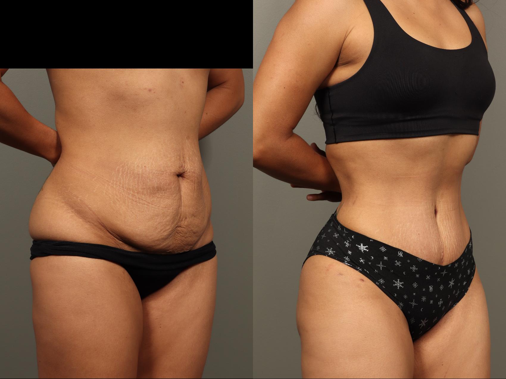 Before & After Abdominoplasty (Tummy Tuck) Case 499 Left Side View in Gilbert, AZ