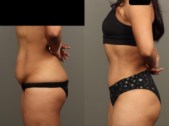 Before & After Abdominoplasty (Tummy Tuck) Case 499 Right Oblique View in Gilbert, AZ